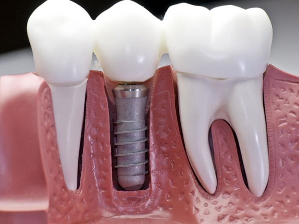 Kayseri İmplant: Gürses Dental ile Sağlam ve Estetik Dişlere Adım Atın