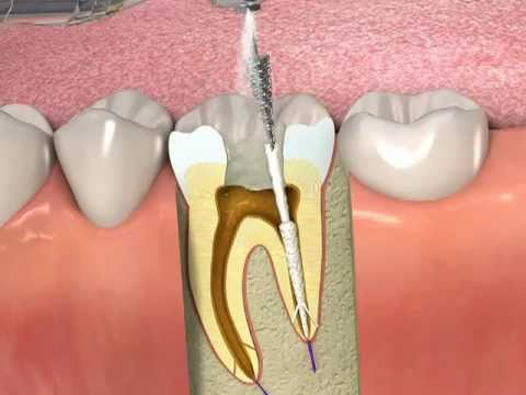 Kanal Tedavisi  Endodonti 