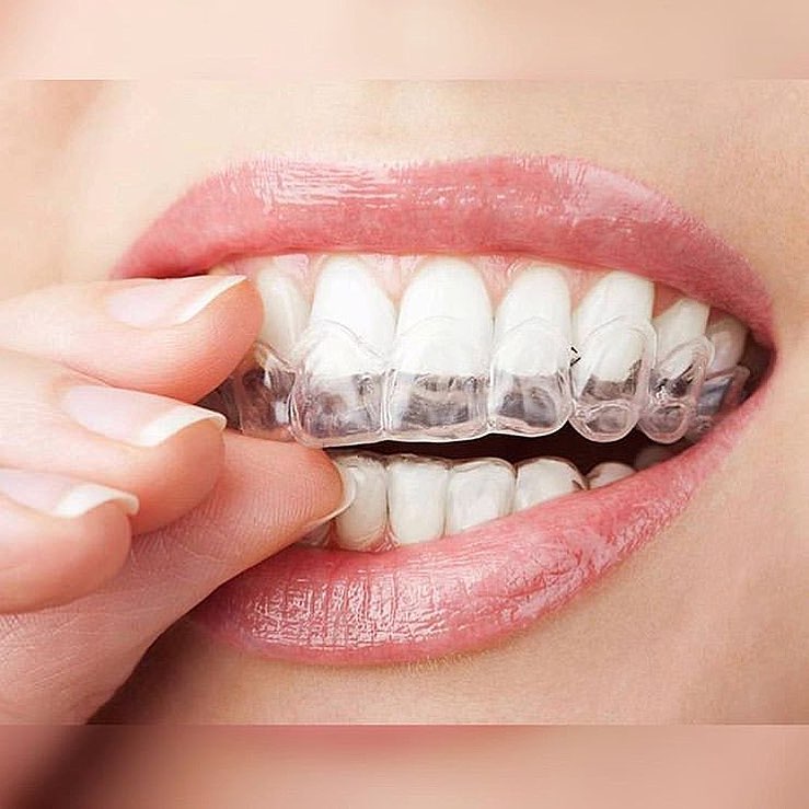 kayseri-Invisalign tedavisi