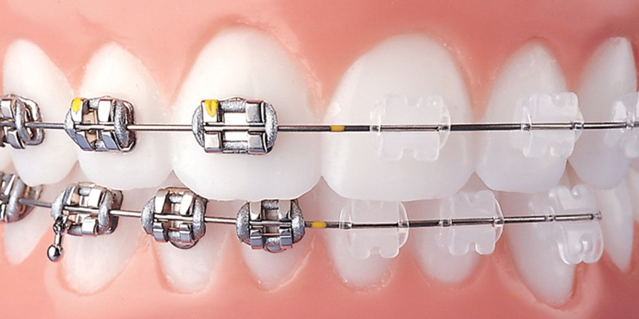 Ortodonti Diş Teli 